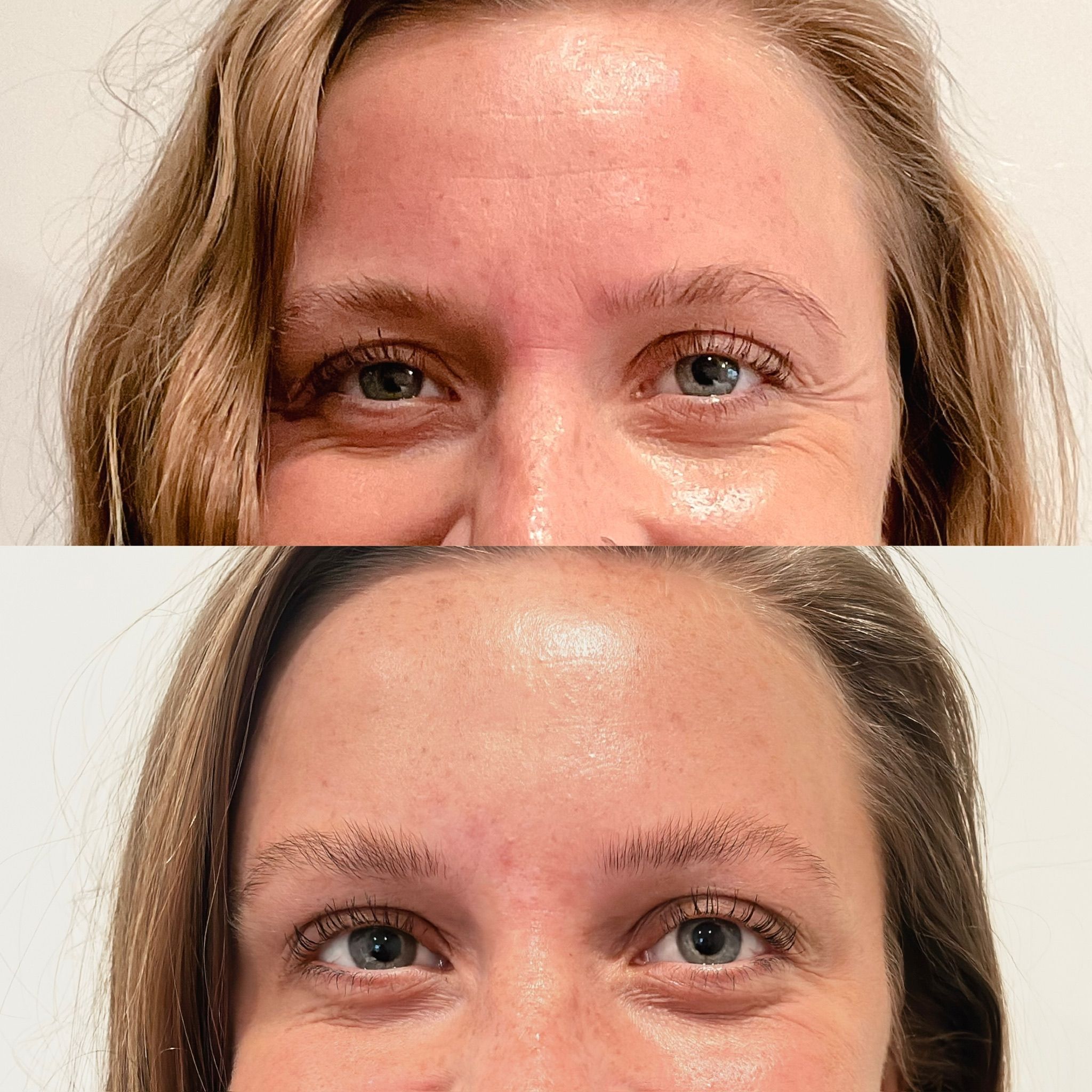 Botox crow's feet before & after treatment at Be Your Kind in Edina