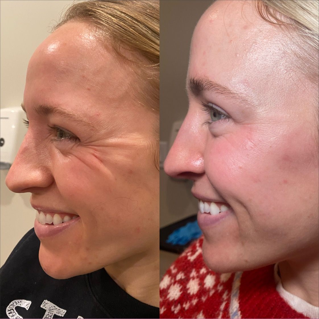 Botox crow's feet before & after treatment at Be Your Kind in Edina