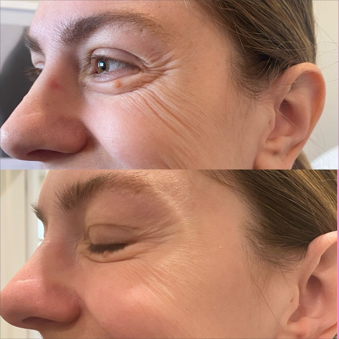 Botox crow's feet before & after treatment at Be Your Kind in Edina