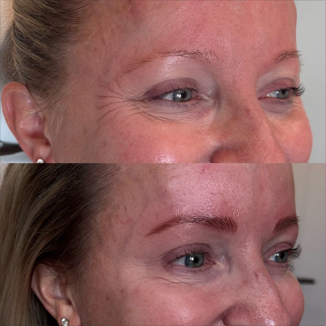 Botox crow's feet before & after treatment at Be Your Kind in Edina