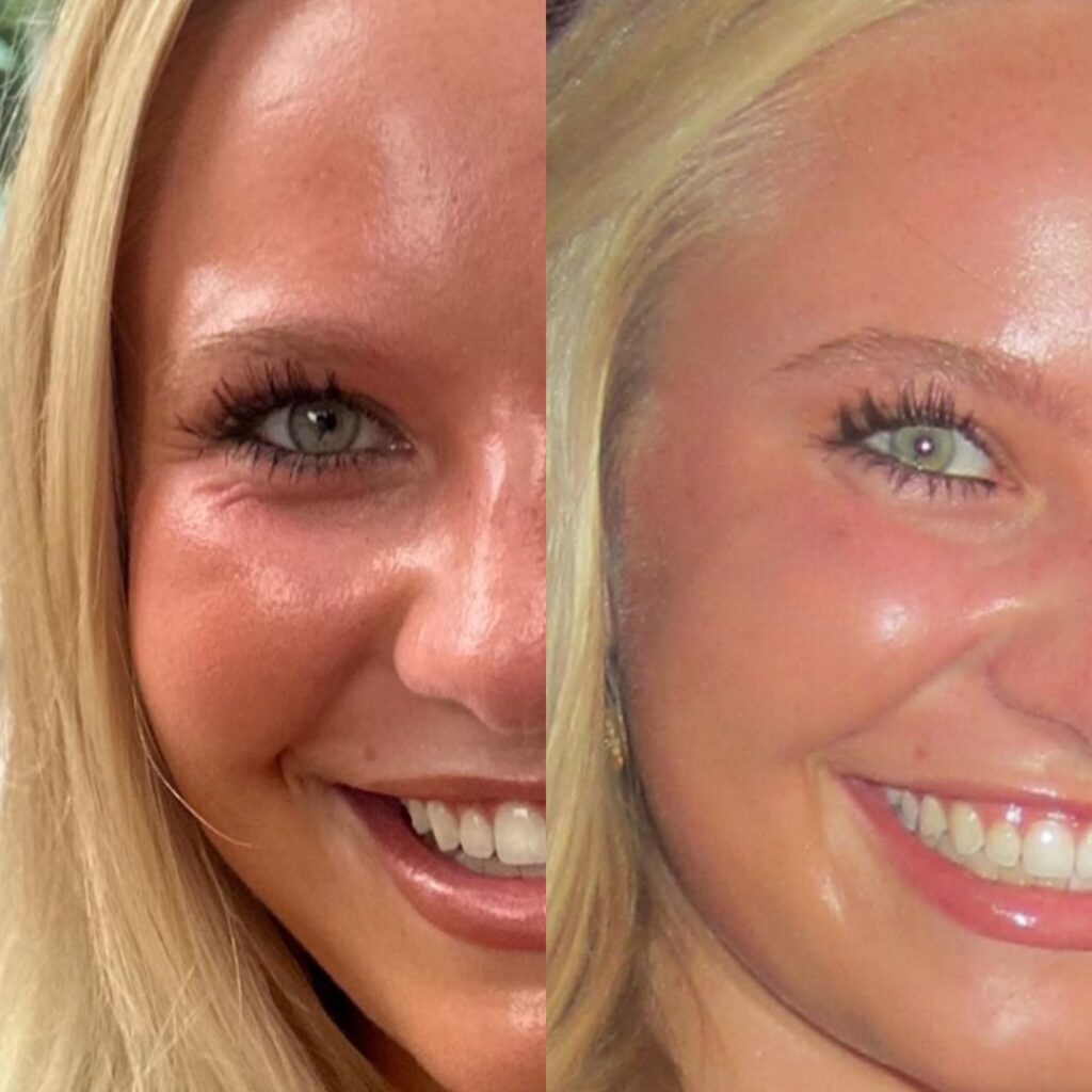 Botox crow's feet before & after treatment at Be Your Kind in Edina