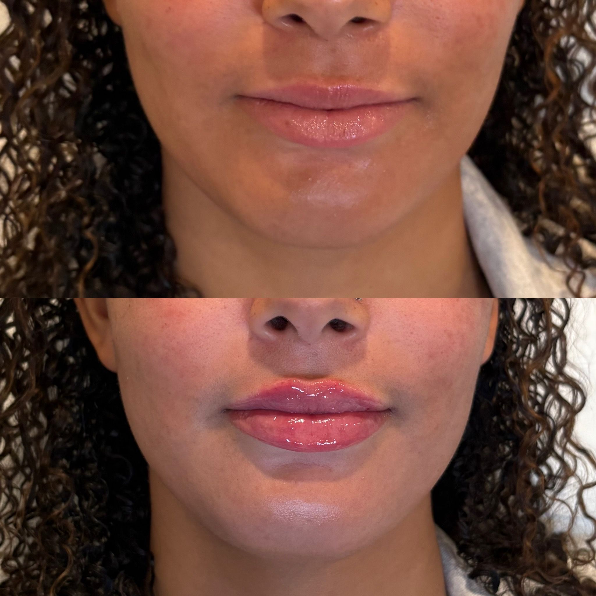 Lip filler before and after result with natural volume and improved lip definition