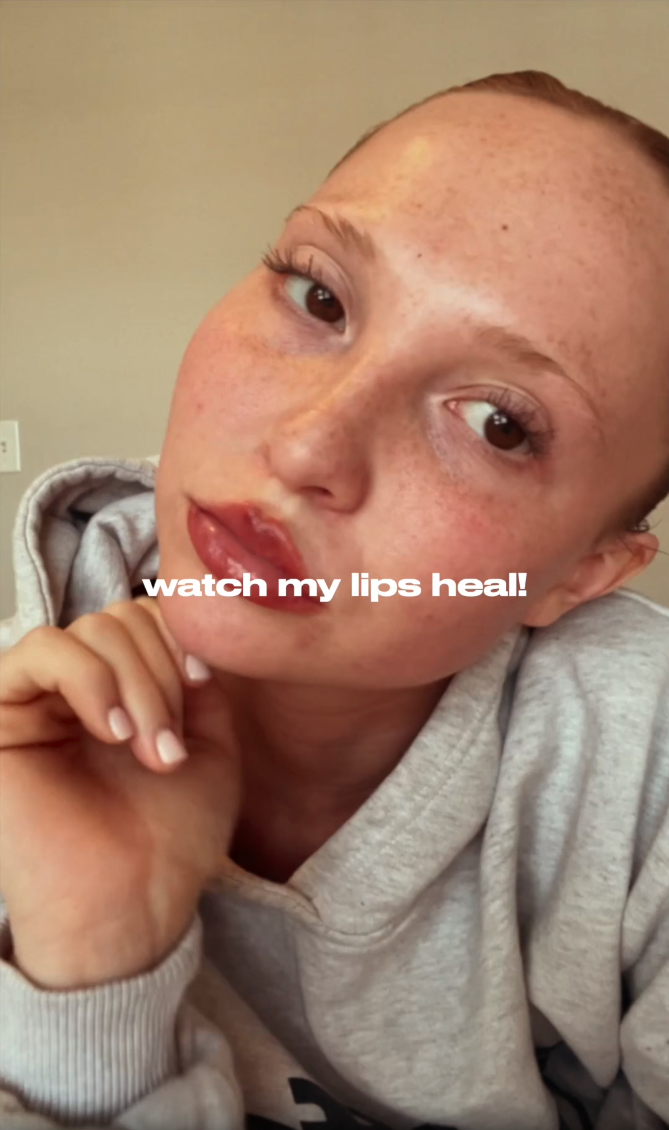 Day 1 of lip filler healing process