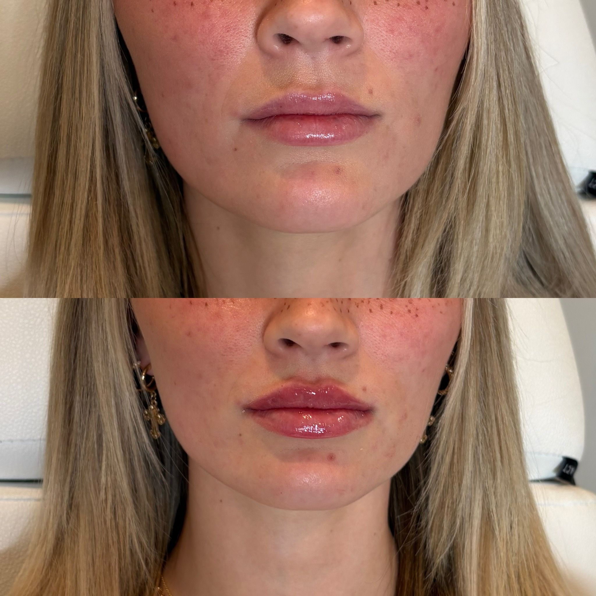 Lip filler before and after showing fuller, more defined lips on a Be Your Kind client